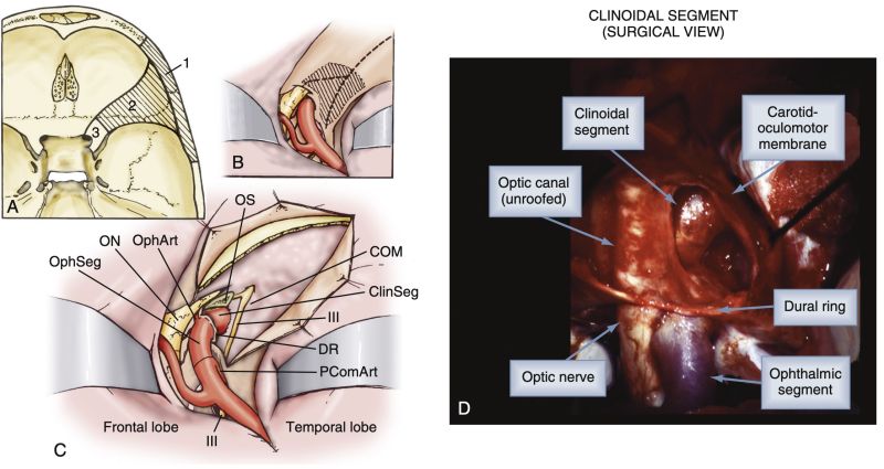 File:Bony and dural resection for paraclinoid aneurysm surgery.jpg