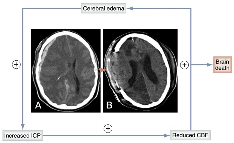 File:The vicious cycle of head injury.jpg
