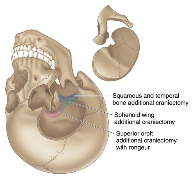 File:Frontotemporal Craniotomy with Orbitozygomatic Osteotomy.jpg