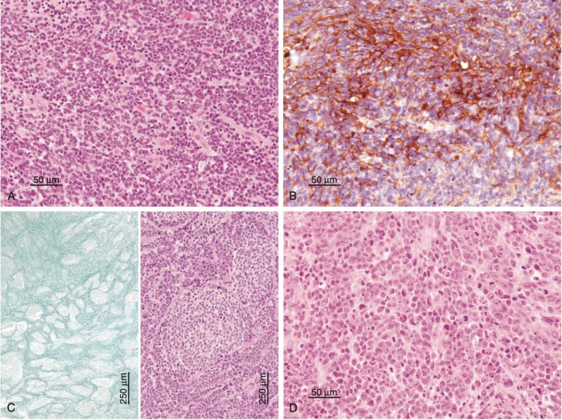 File:Medulloblastoma - subtypes.jpg