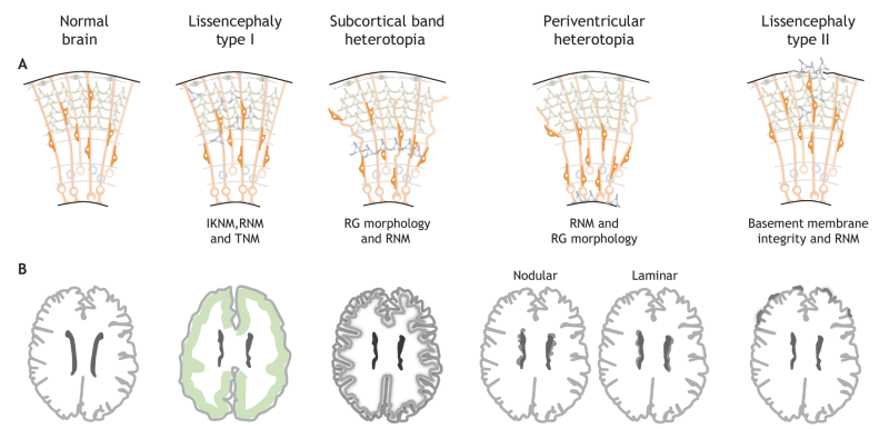 (A) Schematics highlighting the cellular basis of NMDs in the adult human cortex, showing the different cortical layers and neuronal migrations. Single ectopic neurons are shown in grey and the affected structures or processes are indicated. (B) Schematic showing the MRI-detectable morphological defects in the adult human brain that are caused by the cellular defects of each NMD. Ectopically located clusters of affected neurons are shown as greyshading. Lissencephaly type I is characterized bya smooth brain surface and a simplified fourlayered cortex (indicated by green shading). In subcortical band heterotopia, the cortex contains an additional band of grey matter underneath the white matter. Periventricular heterotopia is characterized by clusters (nodular) or sheets (laminar) of neurons accumulating at the ventricles underneath a normal cortex. In lissencephaly type II, neuronsovermigrate ontothecorticalsurface. Schematicsareadapted fromMRIimages,seee.g.BizzottoandFrancis,2015;Francisetal., 2006; Guerrini and Parrini, 2010. IKNM, interkinetic nuclear migration; RG, radial glia; RNM, radial neuronal migration; TNM, tangential neuronal migration.